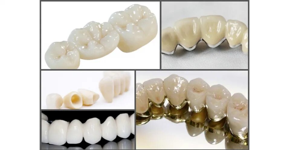 Зубная коронка металлокерамика. Коронка металлокерамическая кхс что это. Какие зубы из металлокерамики. Какие зубы из металлокерамики. Металлокерамика коронки на передние зубы.