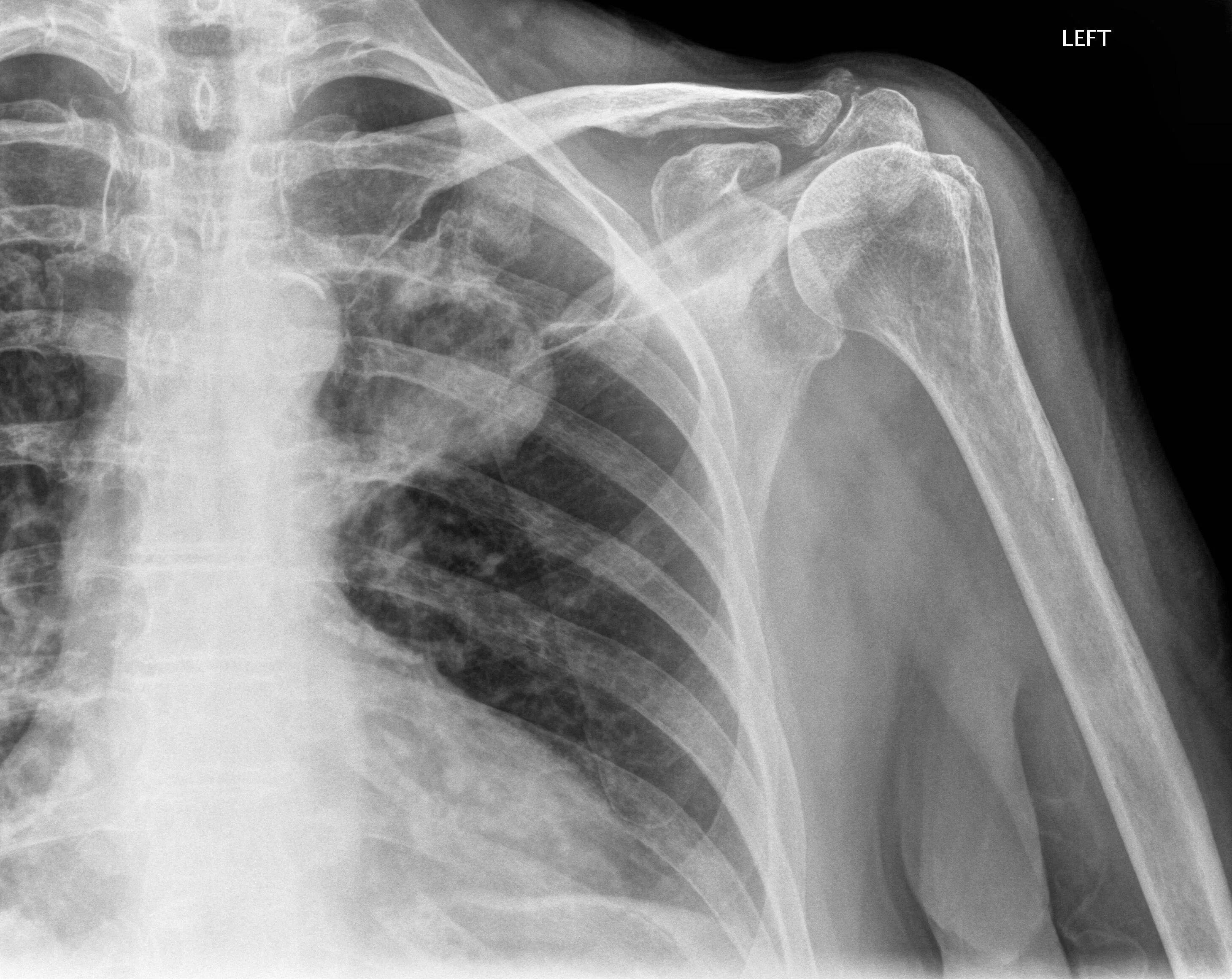 D a xray monolith. Рентгенопельвиометрия. Цифровая рентгенопельвиометрия. XRAY Shoulder. Радиопедия для рентгенологов.