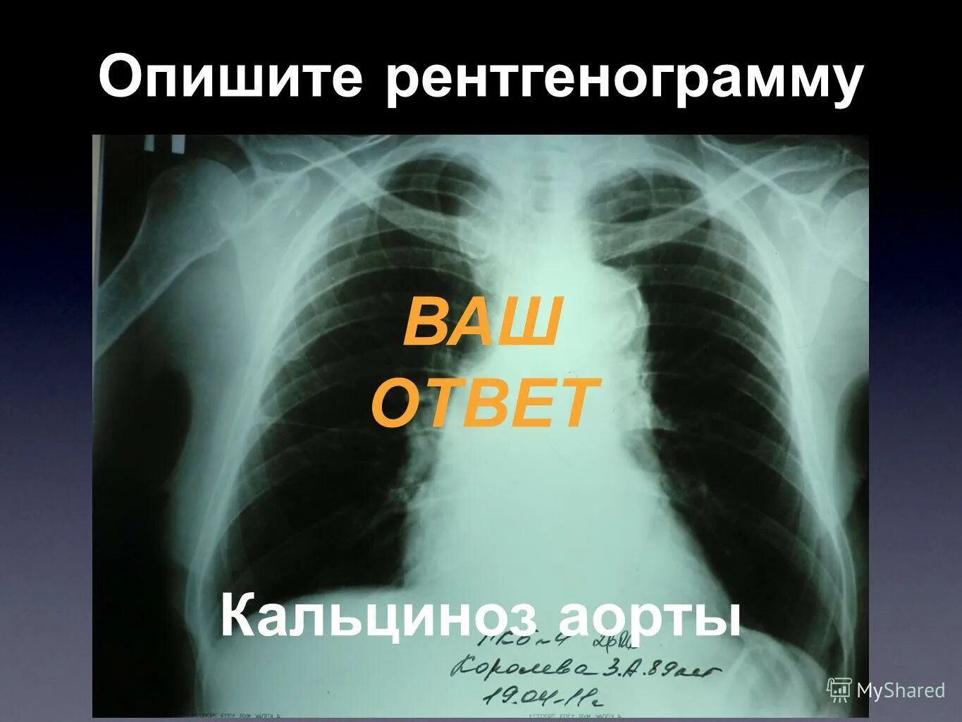 Что значит аорта уплотнена на флюорографии. Что значит аорта уплотнена на флюорографии