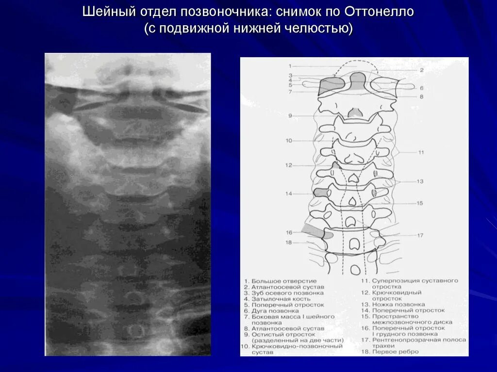 Шейный отдел позвоночника рентген с1-с2. Анатомия шейных позвонков рентген. Полулунные отростки шейных позвонков на рентгене.