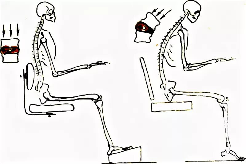 Профилактика остеохондроза поясничного отдела. Нагрузка на позвоночник. Нагрузка на позвоночник при сидении. Профилактика остеохондроза шейного отдела. Сидеть после операции на позвоночнике поясничного