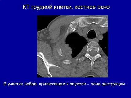 Кт ребер