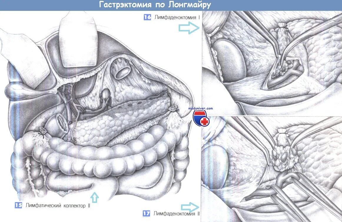 Лимфаденэктомия это. Операция гастрэктомия. Гастрэктомия техника операции. Тотальная гастрэктомия ход операции. Гастрэктомия с реконструкцией по ру.