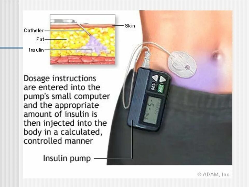 Как вводится инсулин. Инсулиновая помпа для диабетиков 1 типа. Беспроводная инсулиновая помпа для диабетиков 1 типа. Инсулиновая помпа омнипод. Помпа инсулиновая Medtronic 620.