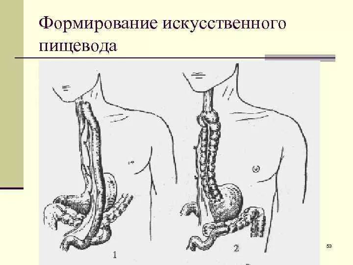 Создание искусственного пищевода. Создание искусственного пищевода. Создание искусственного пищевода. Создание искусственного пищевода. Эзофагопластика пищевода.