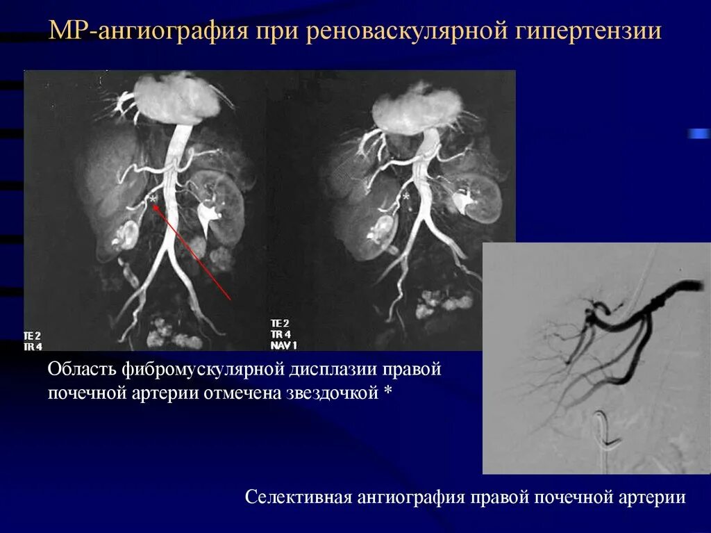 Селективная ангиография сосудов. Фибромышечная дисплазия почечных артерий. Магнитно резонансная ангиография почек. Кт ангиография почечных артерий. Тромбоз почечной артерии