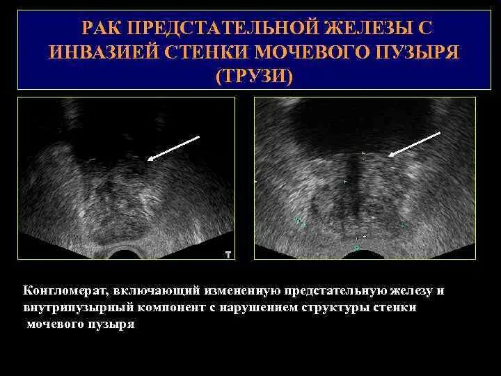 Диффузные предстательной железы. Гиперплазия предстательной железы узи. трансабдоминальное узи предстательной железы. узи исследование предстательной железы. образования предстательной железы на узи.