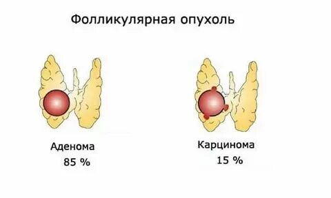 Фолликулярная неоплазия щитовидной высокой степени