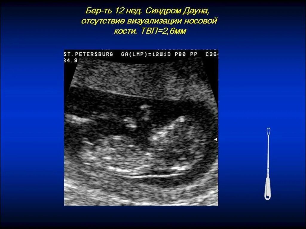 Гипоплазия носовой кости УЗИ. УЗИ носовая кость при синдроме Дауна. УЗИ 1 триместр кость носа.