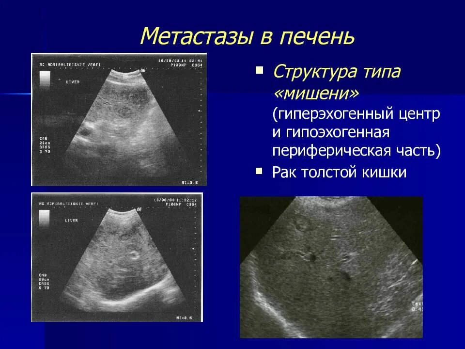 Образование в печени на узи