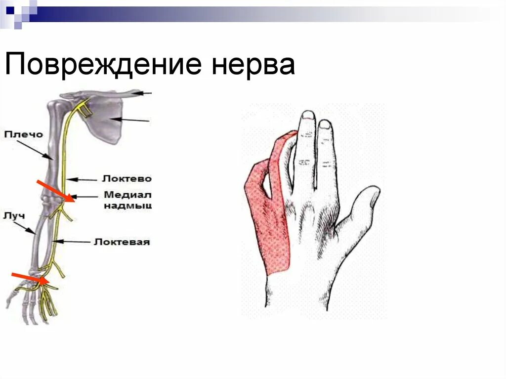 Повреждение локтевого нерва. Повреждение лучевого нерва симптомы. Повреждение локтевого нерва симптомы. Повреждение лучевого нерва кисти. Синдром компрессии лучевого нерва.