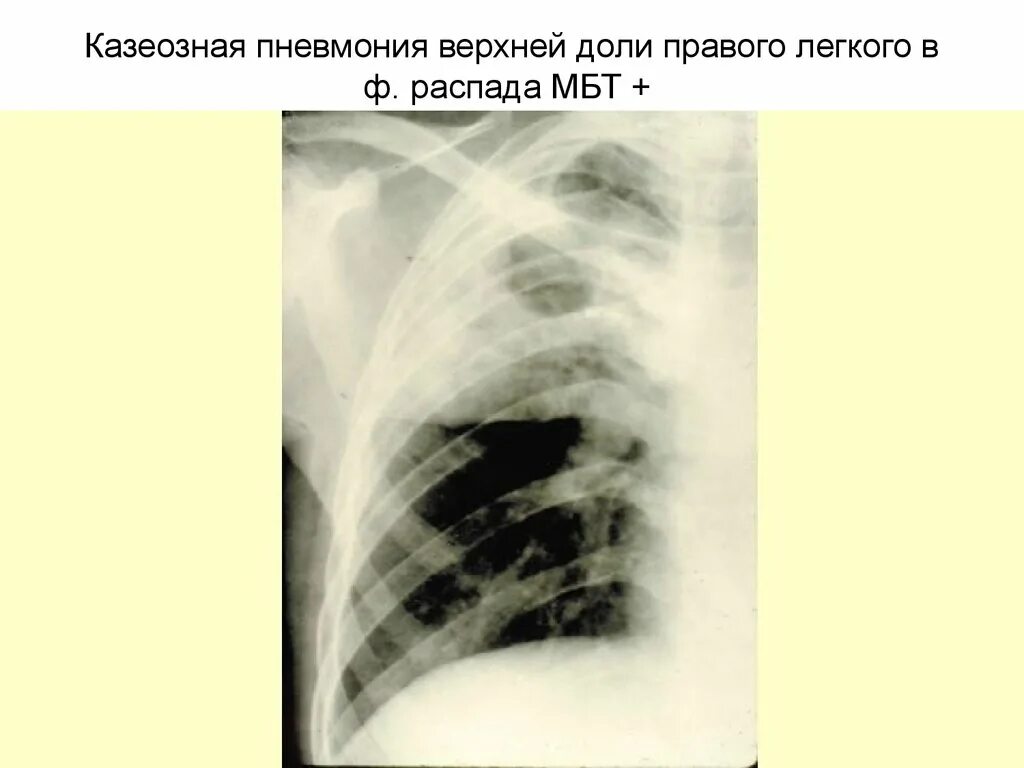 Изменения в верхней доле легкого. Казеозная пневмония туберкулез рентген. Ацинозная казеозная пневмония. Казеозная пневмония рентгенограмма. Казеозная пневмония диссеминированный туберкулез.