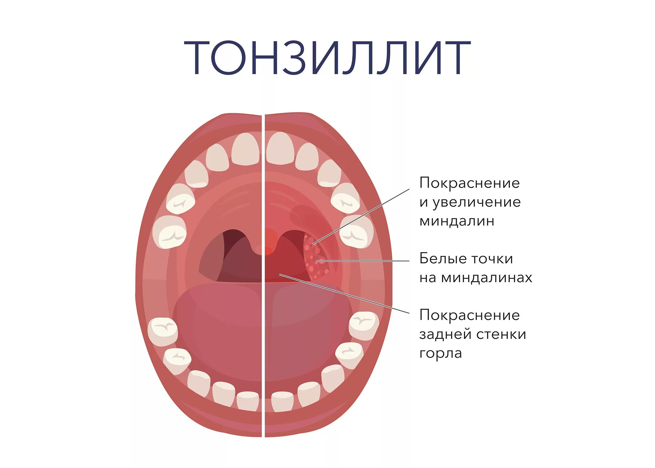 Хронический тонзиллит гнойные пробки. Хронический тонзиллитсимпомы. Воспаление острого хронического тонзиллита. Хронический тонзиллит налет.