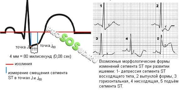Подъем сегмента st на экг на 3 мм. Косонисходящая депрессия сегмента st в v4-v6. Горизонтальная депрессия сегмента st на экг. Депрессия сегмента st на экг. Элевация сегмента st на экг v2 v3.