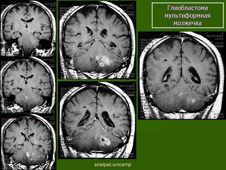 Мультиформная глиобластома. Мультиформная глиобластома причины. Мультиформная глиобластома осложнения. Глиобластома головного мозга гистология.