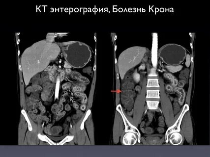 Энтерография