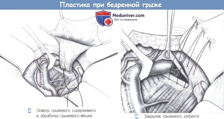 Операция бассини при бедренных грыжах. Пластика бедренной грыжи. Операция бассини бедренная грыжа. Герниотомия бедренной грыжи. Способ бассини бедренной грыжи.