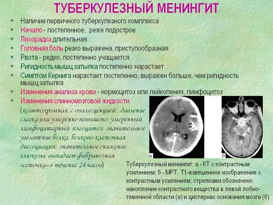 Туберкулез мозговых оболочек кт. Туберкулезный менингоэнцефалит кт. Туберкулёз мозговых оболочек и ЦНС диагностика. Клинические симптомы туберкулезного менингита. Нервный туберкулез