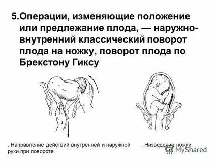 Тазовое положение плода