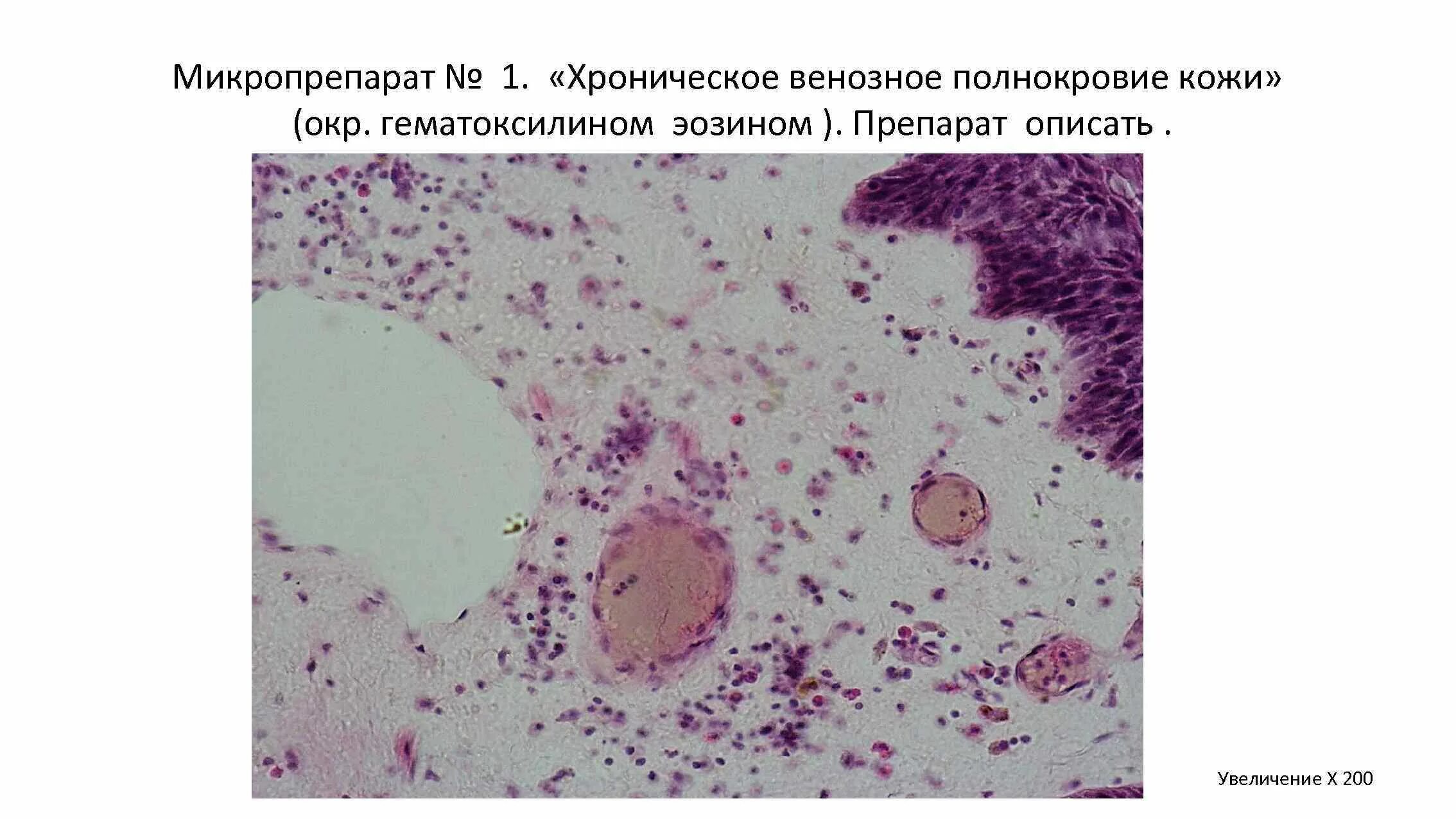 Хроническое полнокровие печени. Венозное полнокровие патанатомия. Хроническое венозное полнокровие микропрепарат. Венозное полнокровие печени мускатная печень. Микропрепарат №28 венозное полнокровие печени.