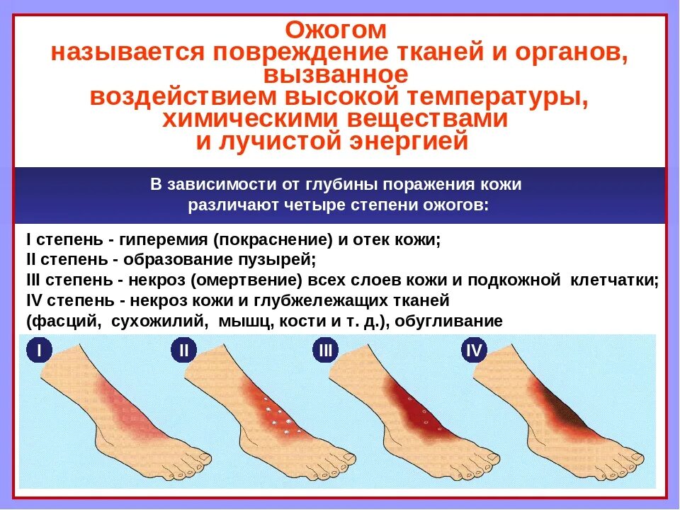 Ожог 2 степени степень тяжести. Характерный признак термического ожога IV степени. Степень ожога ПМП 4 степени. Ожог 1 и 2 степени первая помощь. К глубоким термическим ожогам относят ожоги степени тяжести.