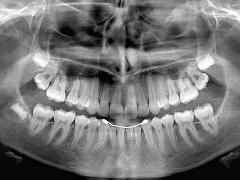 Снимок зубов видное. Ортопантомограмма пародонтит. Рентген ОПТГ зубных рядов. Ортопантомограмма челюсти.