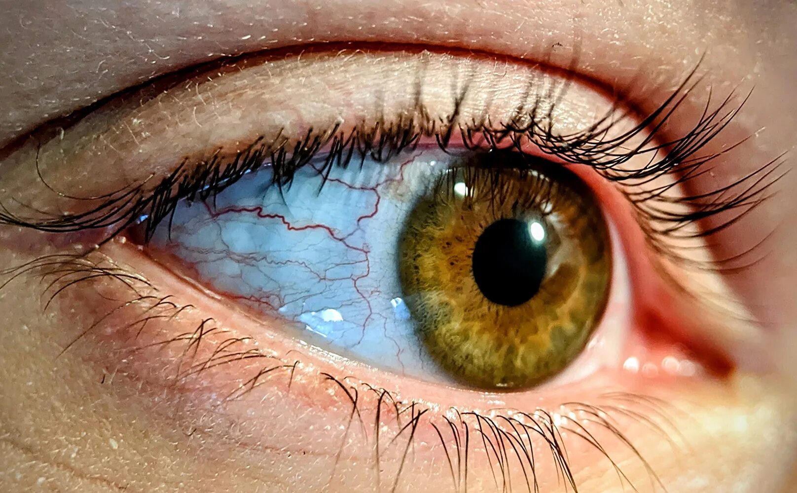 Капилляры на белках глаз. Ухудшается зрение на одном глазу