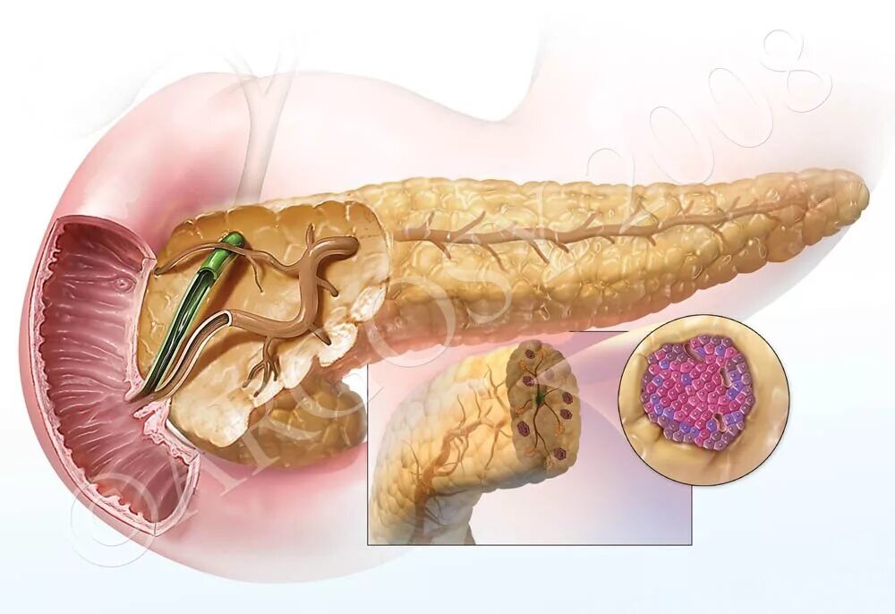 Панкреатит симптомы заболевания. Поджелудочная железа pancreas. Панкреатит макропрепарат. Паротитный панкреатит. Фиброз панкреатит поджелудочной железы.