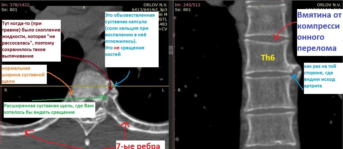 Сакроилеит на кт. Спондилит кт. болезнь бехтерева кт. сакроилеит при болезни бехтерева.