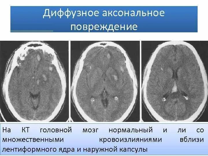 Диффузное аксональное повреждение кт. Аксональное повреждение головного мозга на кт. Диффузное аксональное поражение головного мозга. Диффузно аксональные повреждения головного мозга кт. Диффузное поражение головного