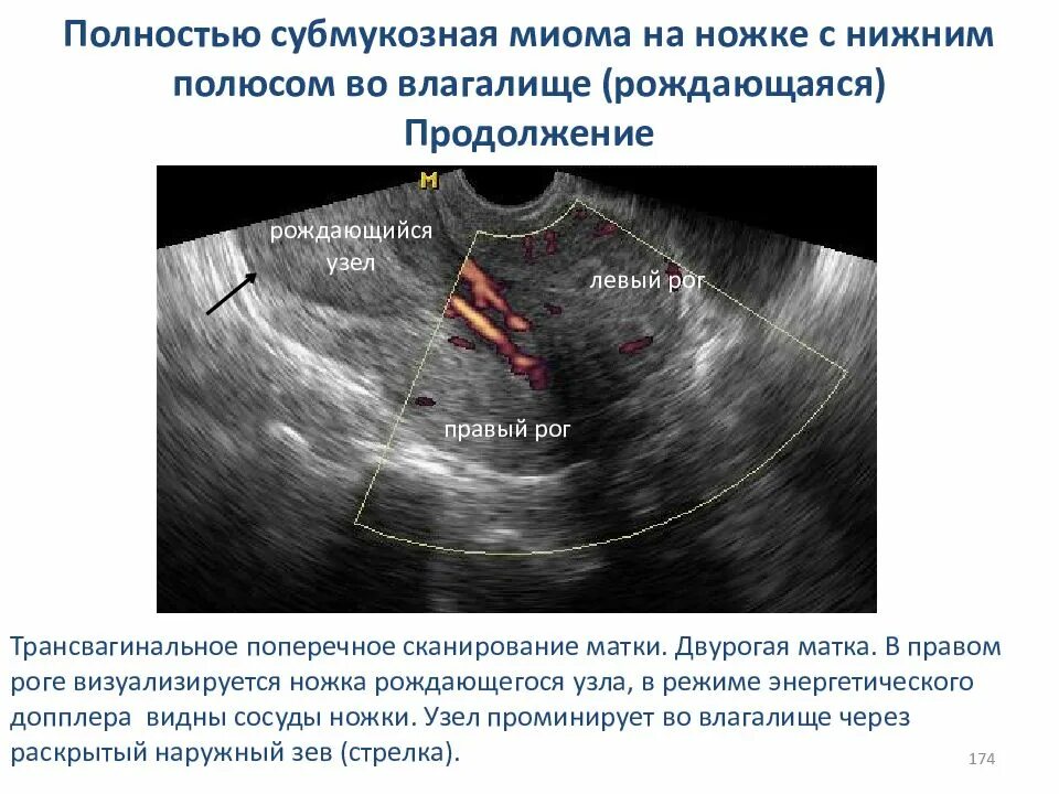 Узлы эндометрия. Интерстициально субмукозная миома. Клинический симптом субмукозной миомы матки:. Миома матки клиника субмукозный.