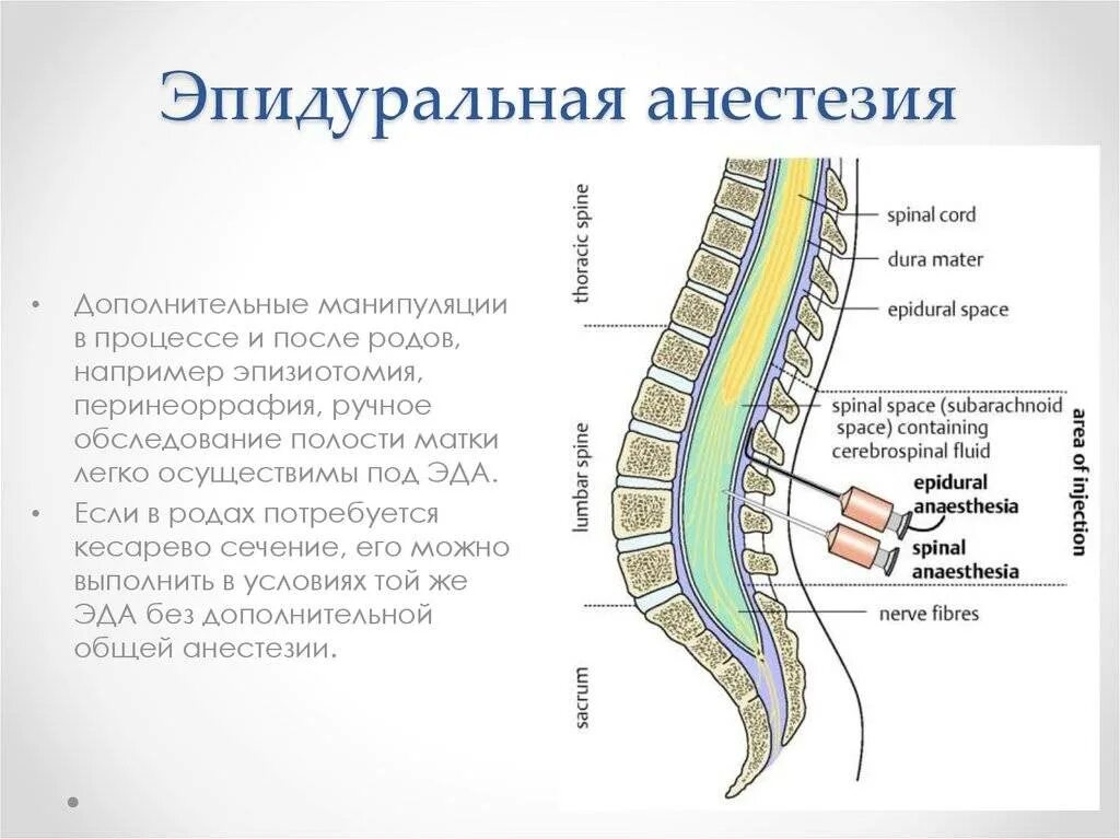 Эпидуральная спинная. Спинальная и эпидуральная анестезия. Анестезия на уровне Корешков спинного мозга. Уровни позвоночника эпидуральная анестезия. Спинальная анестезия при родах техника.