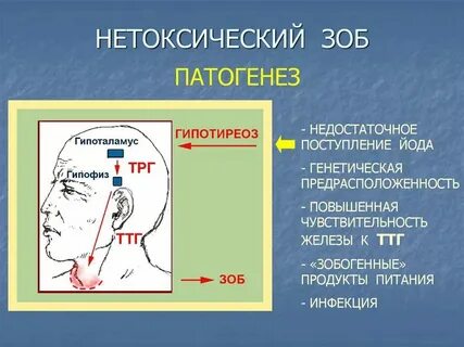 Многоузловой зоб 2 степени