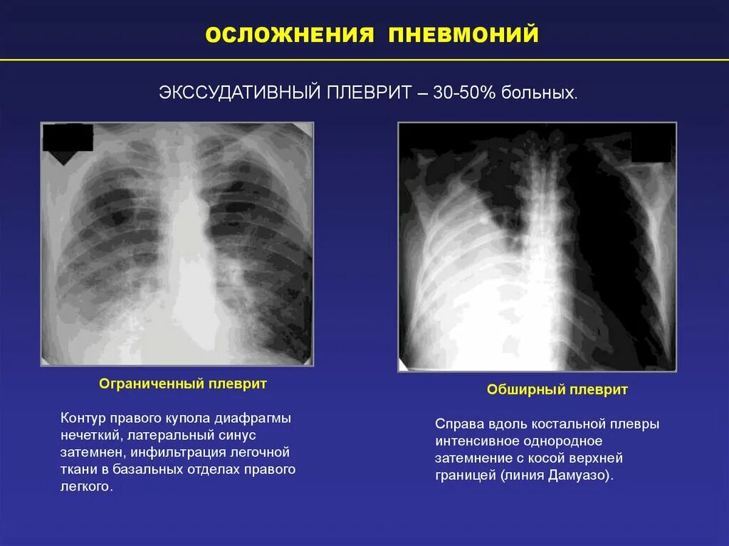 Стадии пневмонии на рентгене. Пневмония осложненная плевритом рентген. Воспалительная инфильтрация легочной ткани пневмония. Апикальные плевральные наслоения рентген. Плевральные осложнения