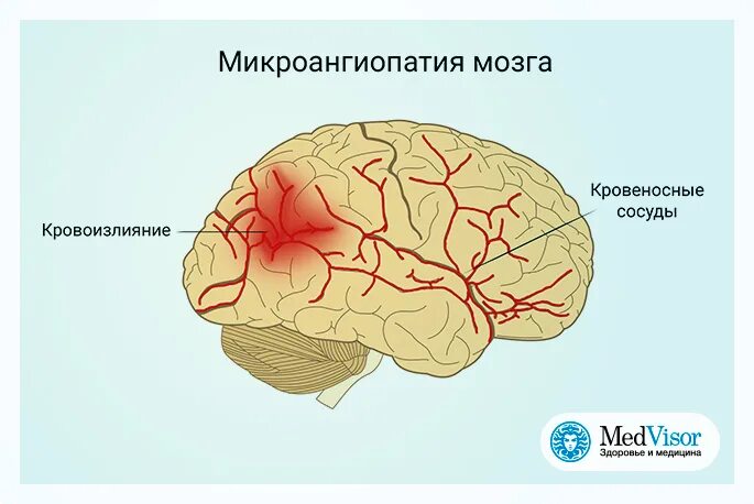 Микроангиопатия головного мозга что это. Микроангиопатия головного мозга что это такое. церебральная микроангиопатия головного мозга что это такое. симптомы микроангиопатии. микроангиопатии сосудов головного мозга.