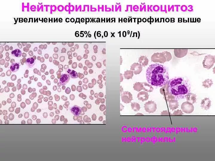 Картина крови при нейтрофильном лейкоцитозе. Лейкоцитоз микроскопия. Нейтрофильный лейкоцитоз кровь. Нейтрофильный лейкоцитоз (нейтрофилез) у детей. Лейкоцитоз нейтрофилы