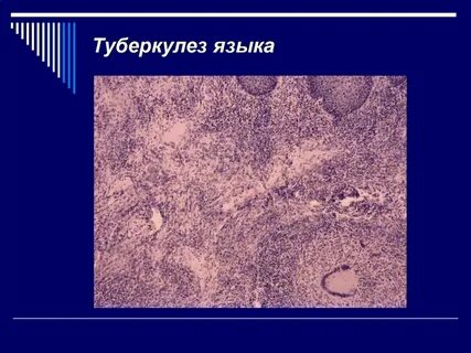 Туберкулезная полость