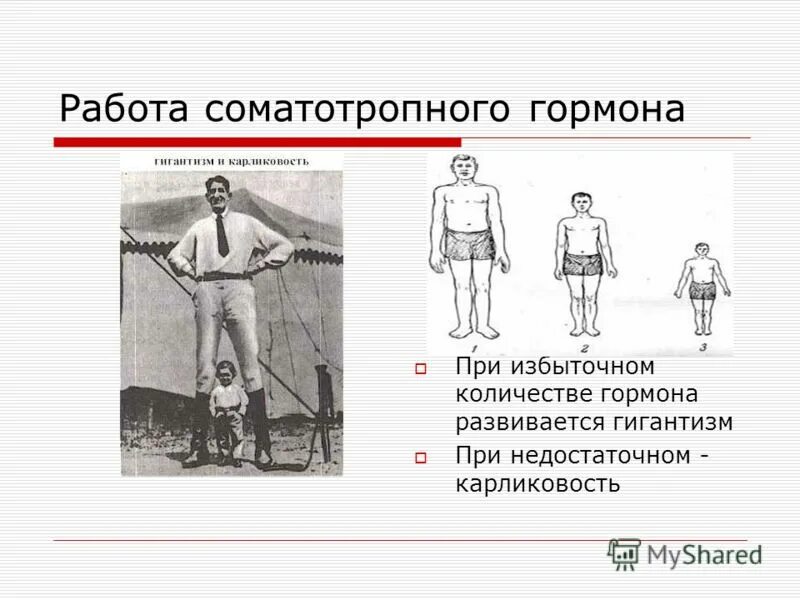 Гормон роста карликовость и гигантизм. Гигантизм ссср. Гипофизарный гигантизм. Болезни при нарушении гормона роста. Гигантизм при избытке.