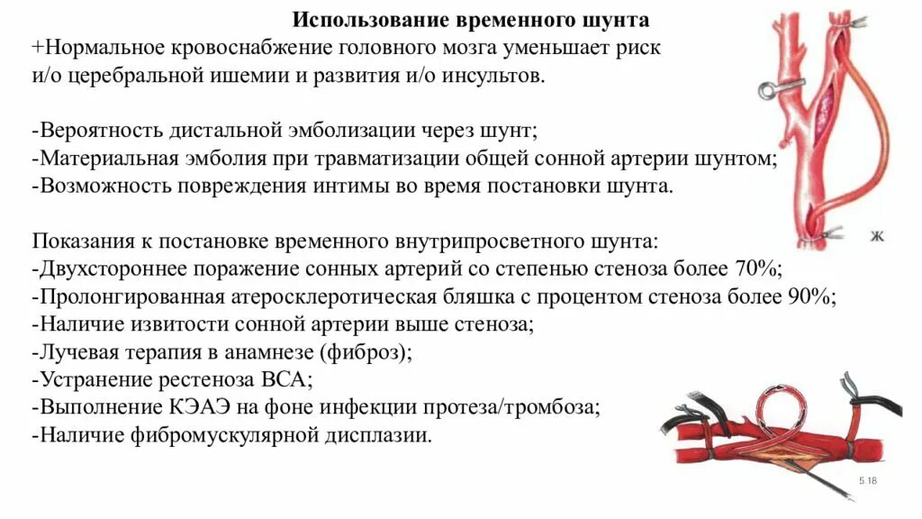 Аневризмы внутренней сонной артерии. Временное шунтирование артерий. После операции на сонную артерию.