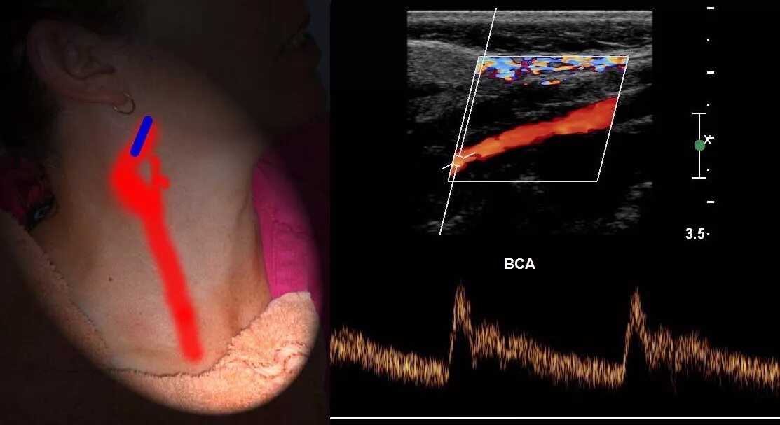 Уздс бца что это. Ультразвуковое триплексное сканирование сосудов дуги аорты. УЗДГ – ультразвуковая допплерография сосудов. Стеноз сонной артерии УЗДГ. Допплеровское сканирование сосудов шеи.