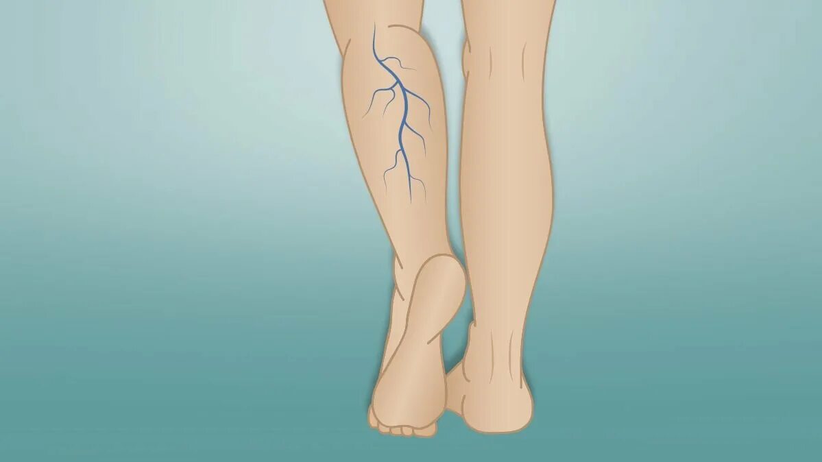Вен стоп. Варикозное расширение вен нижних конечностей профилактика. Дилатация вен нижних конечностей. Варикозное расширение вен нижних конечностей голень.
