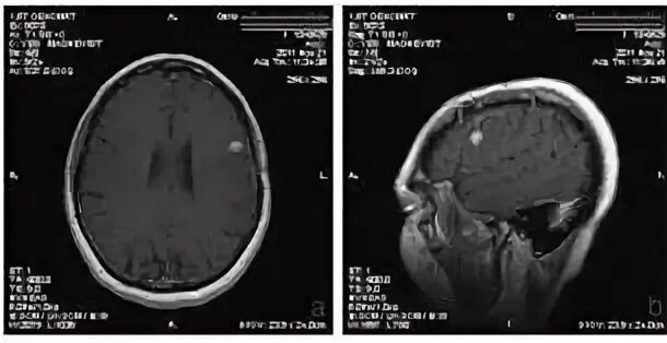 Метастазы головного мозга мрт. Метастазы в головном мозге при нефробластоме. Метастазы в головном мозге симптомы.