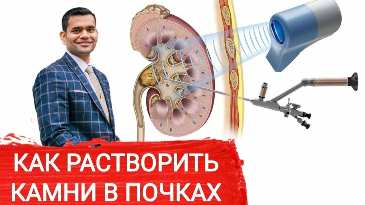 Дробление камней в почках лазером и ультразвуком. Удаление камней из почек воронеж. Нефролитотрипсия перкутанная лазерная. Перкутанная нефролитотрипсия. Удаление камней из почек воронеж.
