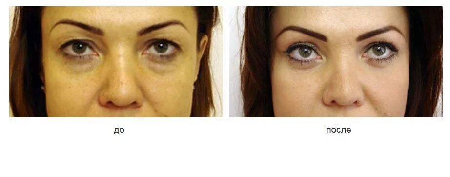 Липофилинг век фото До и После - Cosmetic-clinic