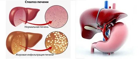 Диффузный стеатоз печени лечение