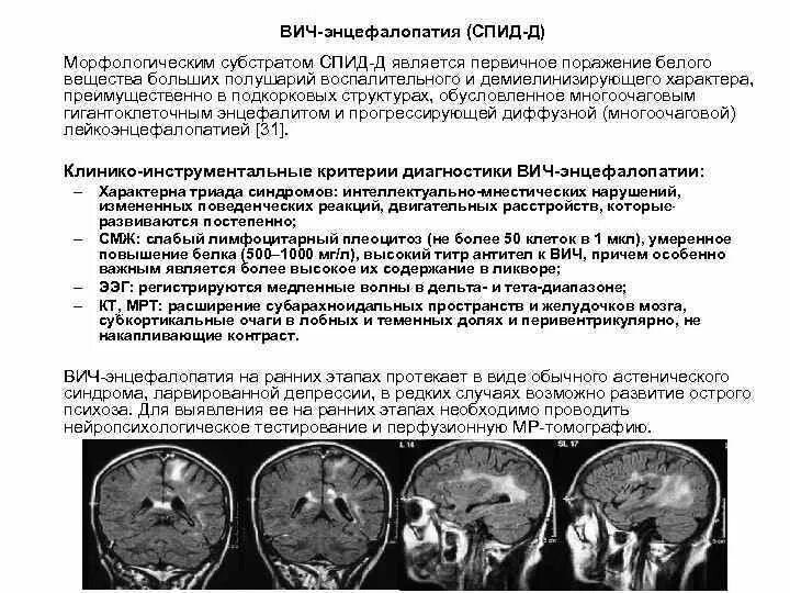 ВИЧ ассоциированная энцефалопатия кт. ВИЧ ассоциированная энцефалопатия мрт. Мрт при ВИЧ энцефалопатии. Энцефалопатия головного мозга на кт. Поражение белого вещества мозга