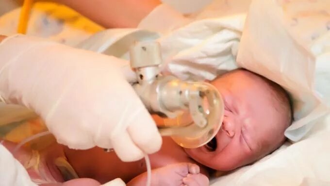 Асфиксии новорожденных клинические. Кислородотерапия новорожденных. Педиатрия асфиксия новорожденного. Кислородотерапия у новорожденного. Болезни новорожденных асфиксия.