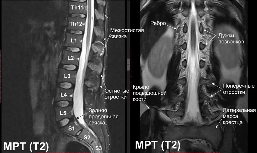 Мрт пояснично-крестцового отдела позвоночника снимки т2. Th5-th12 позвонка. Нумерация позвонков мрт.