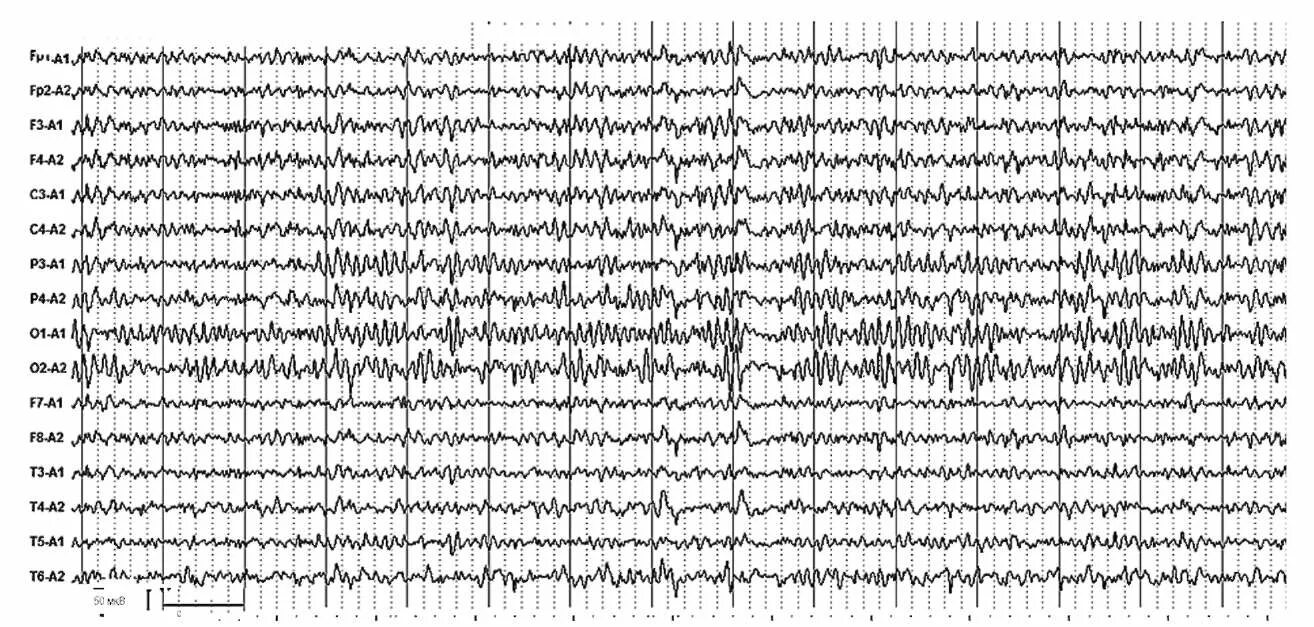 Альфа ритм ЭЭГ. Нерегулярный Альфа ритм на ЭЭГ. Асимметрия Альфа ритма на ЭЭГ. Ритмы на ЭЭГ патология.