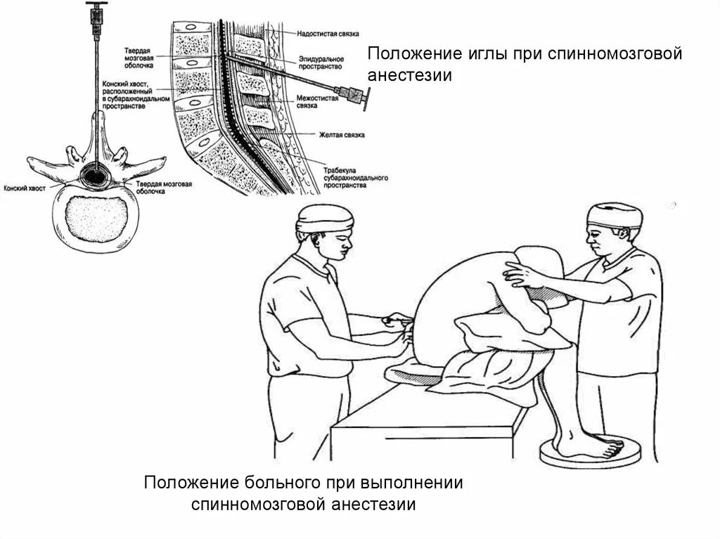 Блокада техника выполнения. Положение больного при спинномозговой анестезии. Спинально эпидуральная анестезия техника проведения. Алгоритм выполнение спинальной анестезии. Положение пациента при эпидуральной анестезии.